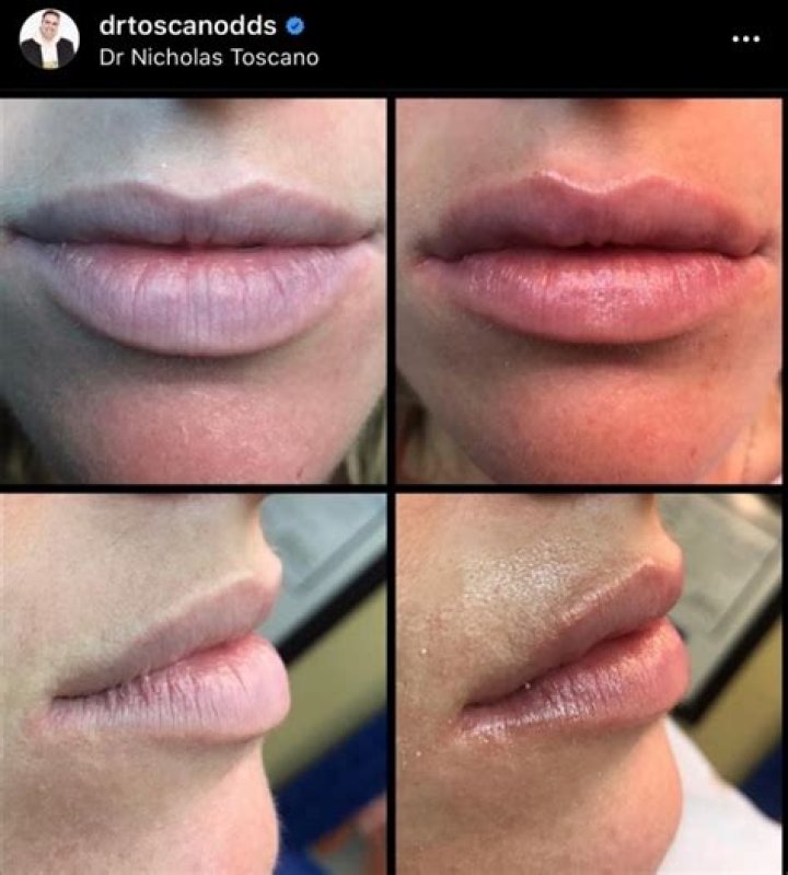 10 Things You Should Know About Dermal Fillers Before Getting Them – Our Interview With Dr Nicholas Toscano On Juvederm