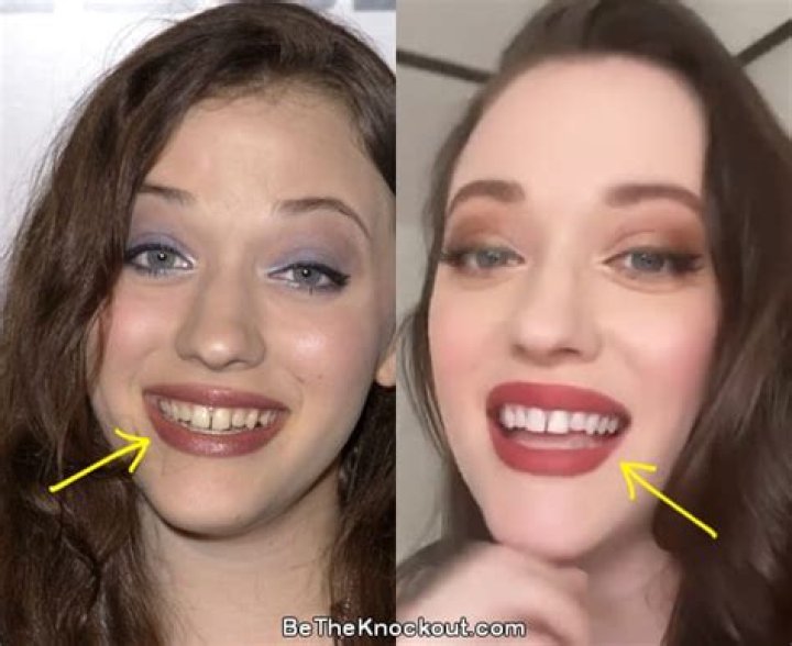 Kat Dennings Plastic Surgery Before and After
