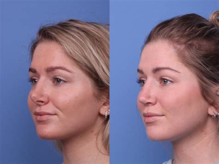 Whitney Port Plastic Surgery Before and After